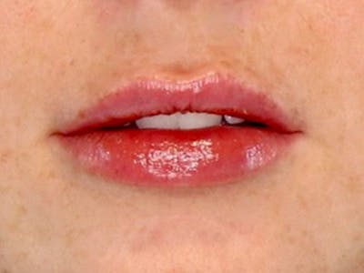 Lip Filler Before & After Gallery - Patient 87552152 - Image 2