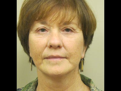 Facelift Before & After Gallery - Patient 87552150 - Image 2