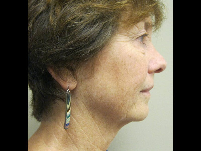 Facelift Before & After Gallery - Patient 87552150 - Image 3