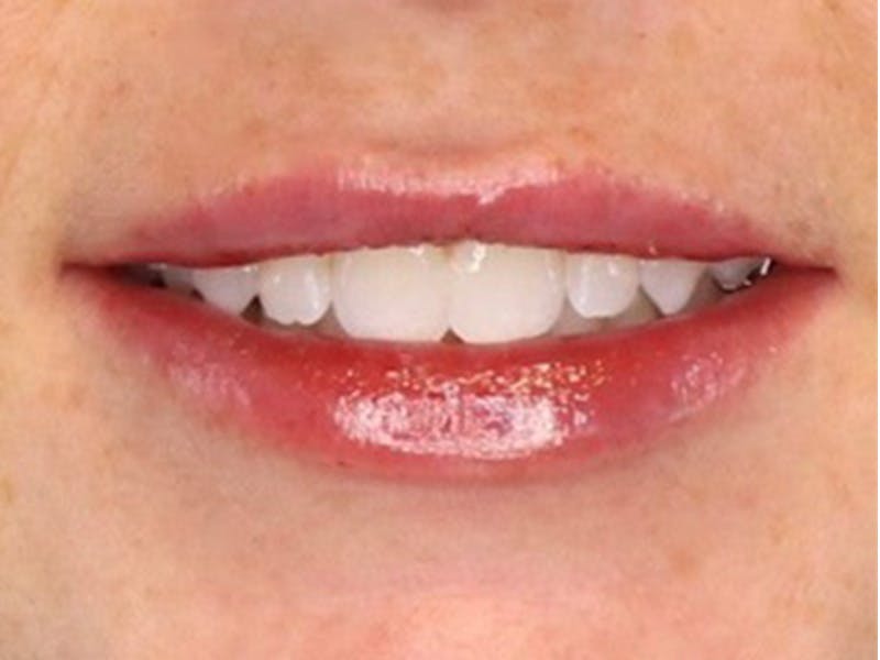 Lip Filler Before & After Gallery - Patient 87552152 - Image 4