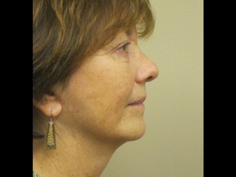 Facelift Before & After Gallery - Patient 87552150 - Image 4