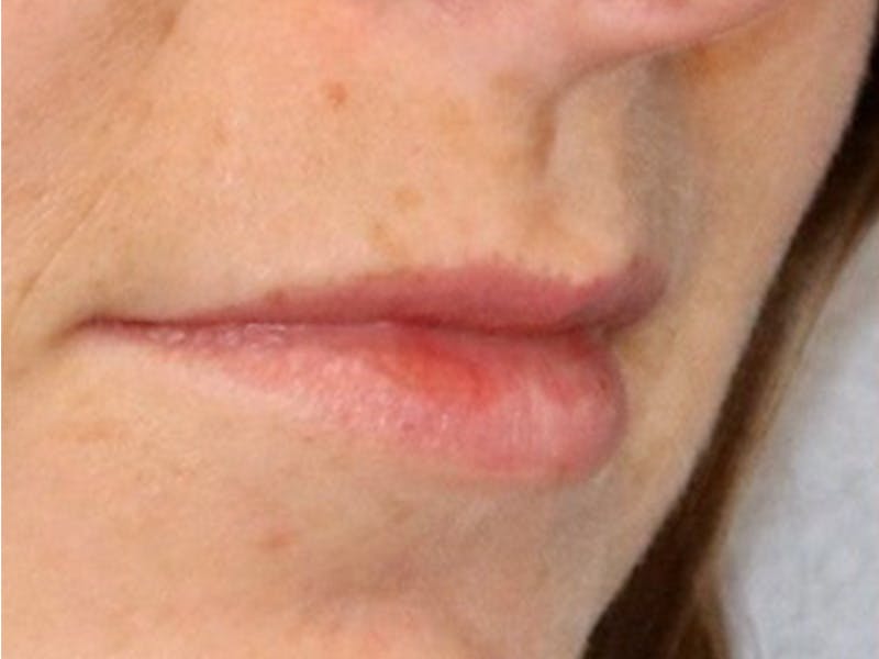 Lip Filler Before & After Gallery - Patient 87552152 - Image 5