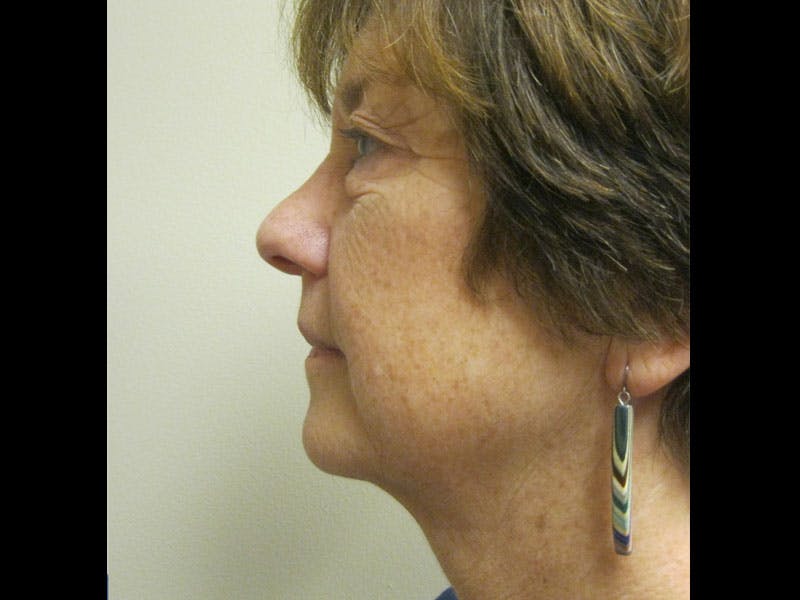 Facelift Before & After Gallery - Patient 87552150 - Image 5