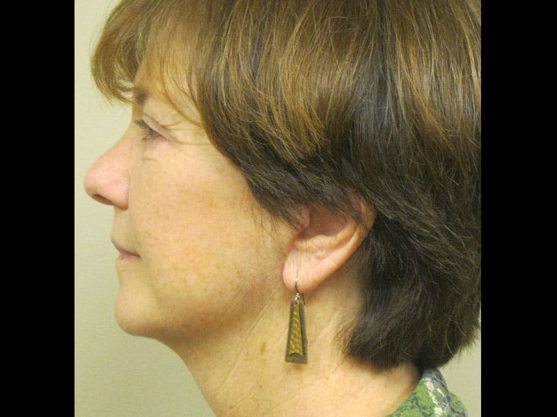 Facelift Before & After Gallery - Patient 87552150 - Image 6
