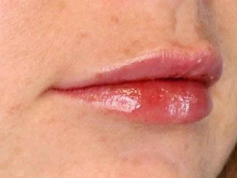Lip Filler Before & After Gallery - Patient 87552152 - Image 6