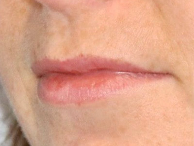 Lip Filler Before & After Gallery - Patient 87552152 - Image 7