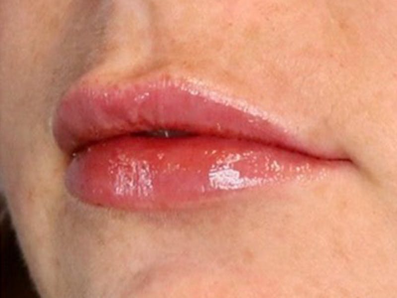 Lip Filler Before & After Gallery - Patient 87552152 - Image 8