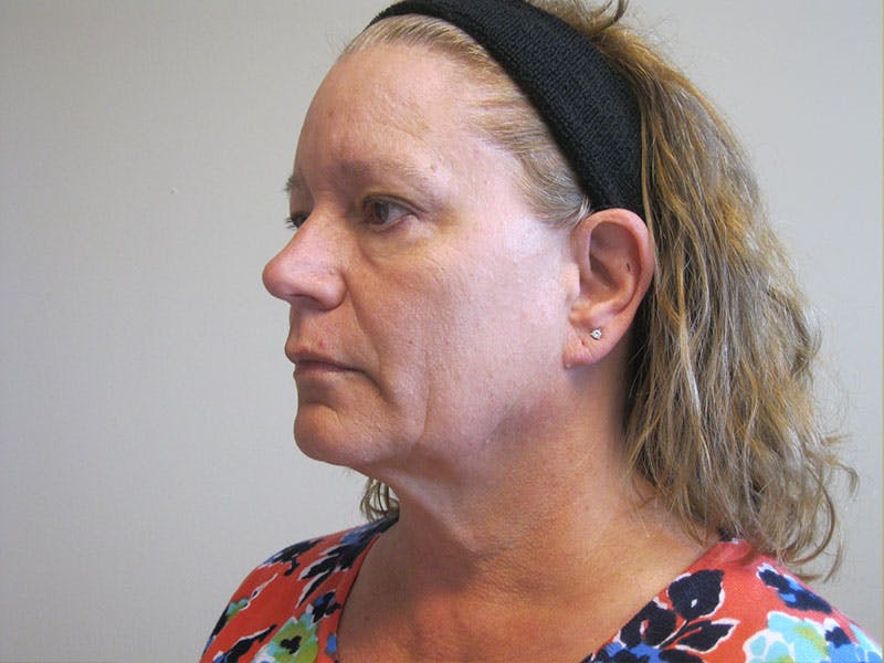 Facelift Before & After Gallery - Patient 87552153 - Image 3