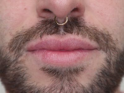 Lip Filler Before & After Gallery - Patient 87552158 - Image 1