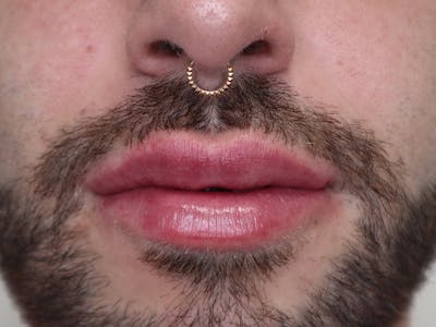 Lip Filler Before & After Gallery - Patient 87552158 - Image 2