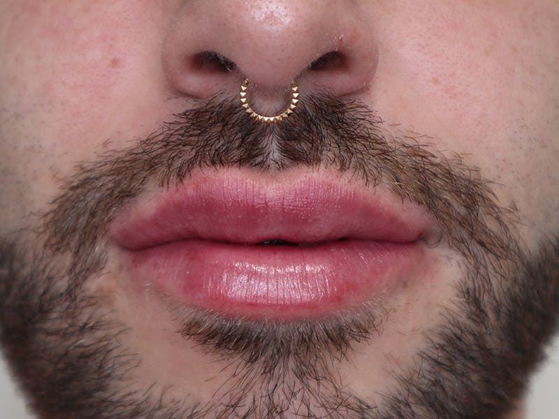 Lip Filler Before & After Gallery - Patient 87552158 - Image 2