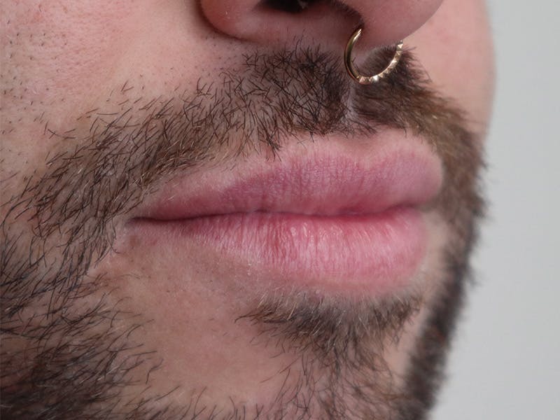 Lip Filler Before & After Gallery - Patient 87552158 - Image 3