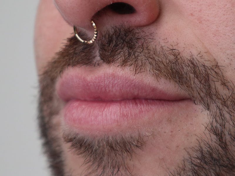 Lip Filler Before & After Gallery - Patient 87552158 - Image 5