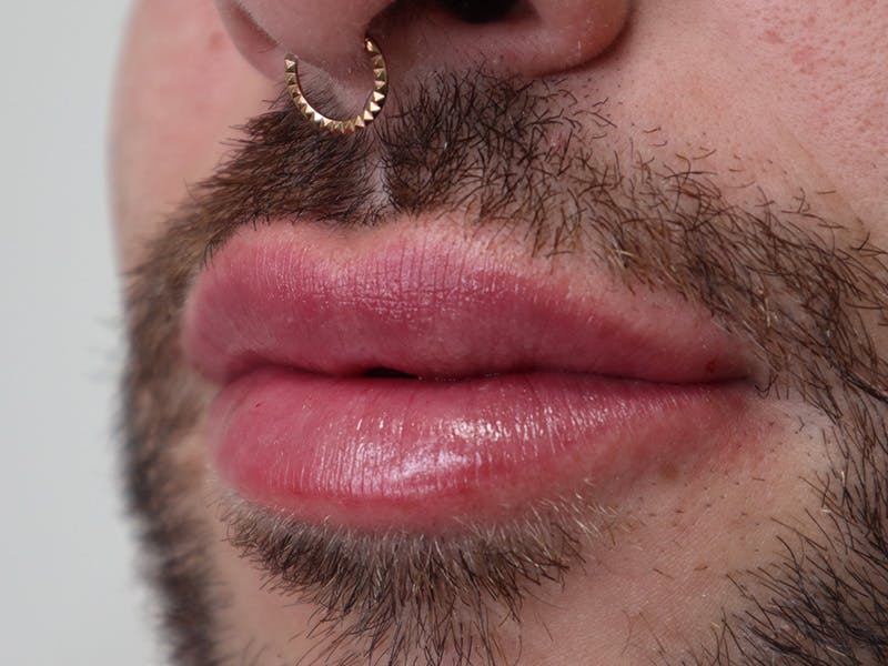 Lip Filler Before & After Gallery - Patient 87552158 - Image 6