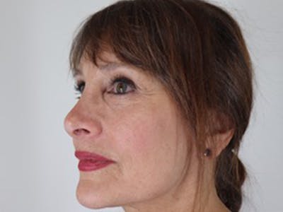 Facelift Before & After Gallery - Patient 87552160 - Image 1