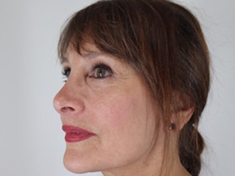 Facelift Before & After Gallery - Patient 87552160 - Image 1