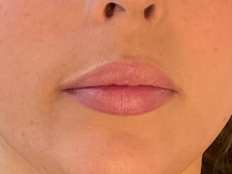Lip Filler Before & After Gallery - Patient 87552159 - Image 1