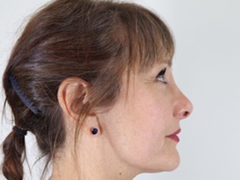 Facelift Before & After Gallery - Patient 87552160 - Image 3