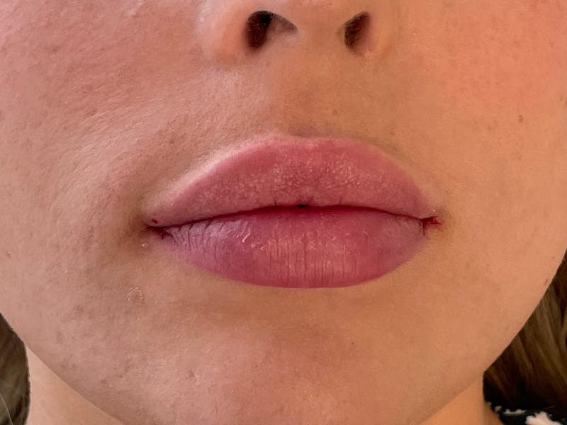 Lip Filler Before & After Gallery - Patient 87552159 - Image 2