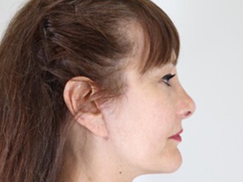 Facelift Before & After Gallery - Patient 87552160 - Image 4