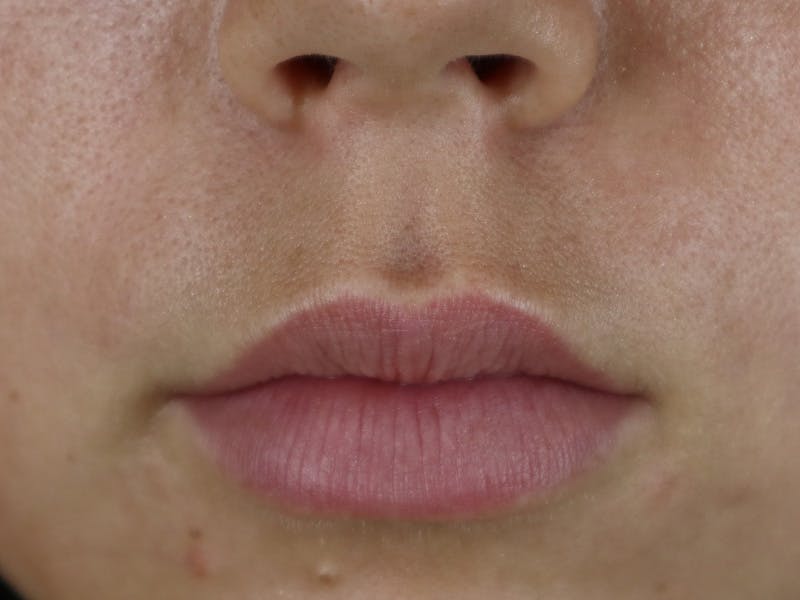 Lip Filler Before & After Gallery - Patient 87552161 - Image 1