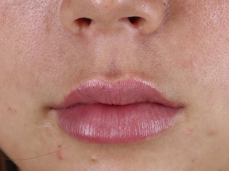 Lip Filler Before & After Gallery - Patient 87552161 - Image 2