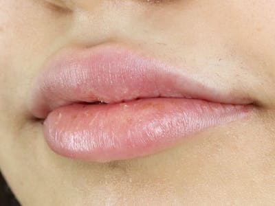 Lip Filler Before & After Gallery - Patient 87553264 - Image 1