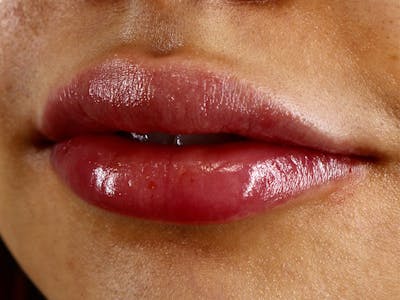 Lip Filler Before & After Gallery - Patient 87553264 - Image 2