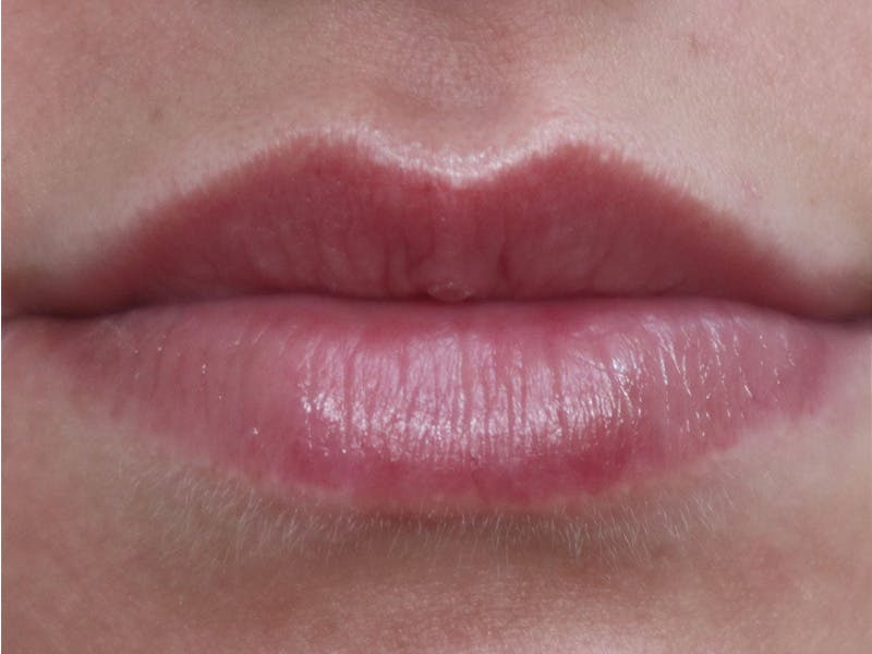 Lip Filler Before & After Gallery - Patient 87555293 - Image 1