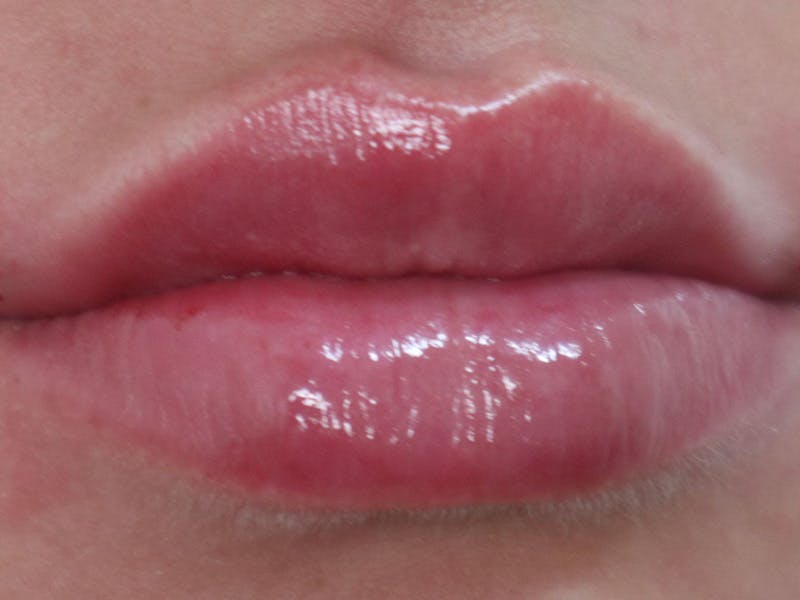Lip Filler Before & After Gallery - Patient 87555293 - Image 2