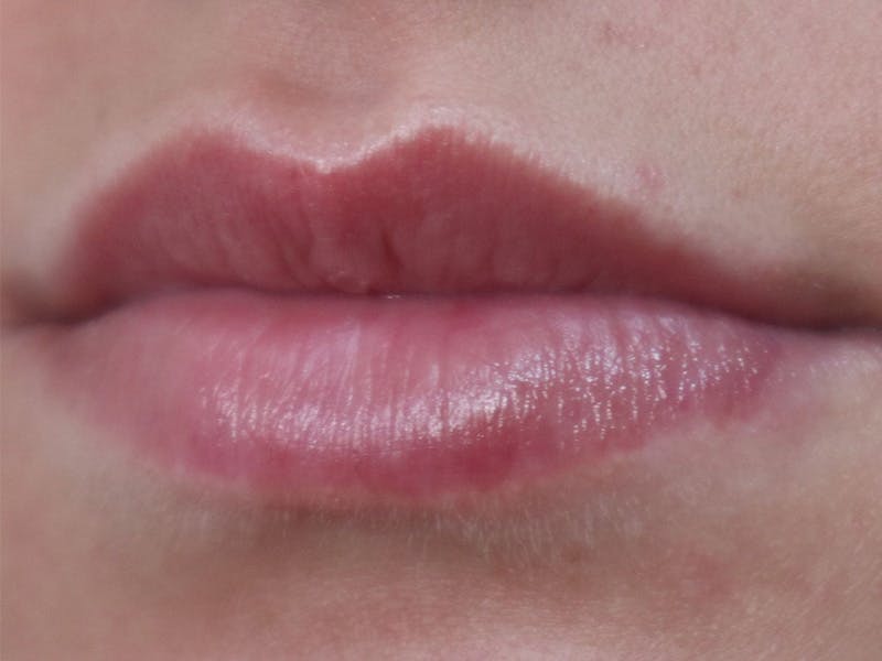 Lip Filler Before & After Gallery - Patient 87555293 - Image 3