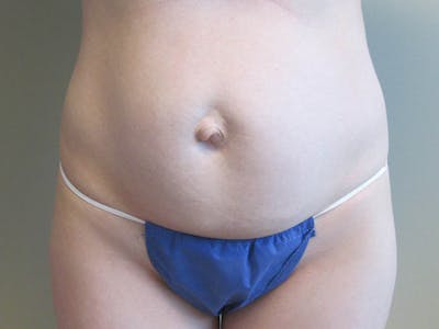 Tummy Tuck Before & After Gallery - Patient 87555305 - Image 1