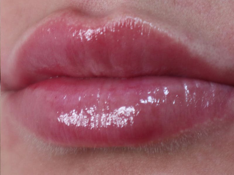 Lip Filler Before & After Gallery - Patient 87555293 - Image 4