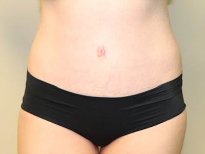 Tummy Tuck Before & After Gallery - Patient 87555305 - Image 2