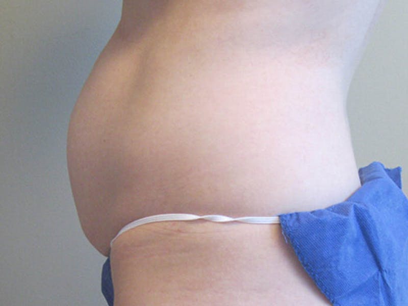 Tummy Tuck Before & After Gallery - Patient 87555305 - Image 3