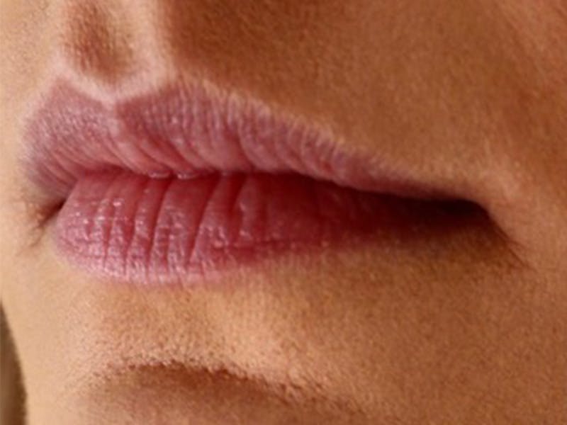 Lip Filler Before & After Gallery - Patient 87555309 - Image 1