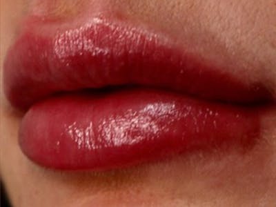 Lip Filler Before & After Gallery - Patient 87555309 - Image 2