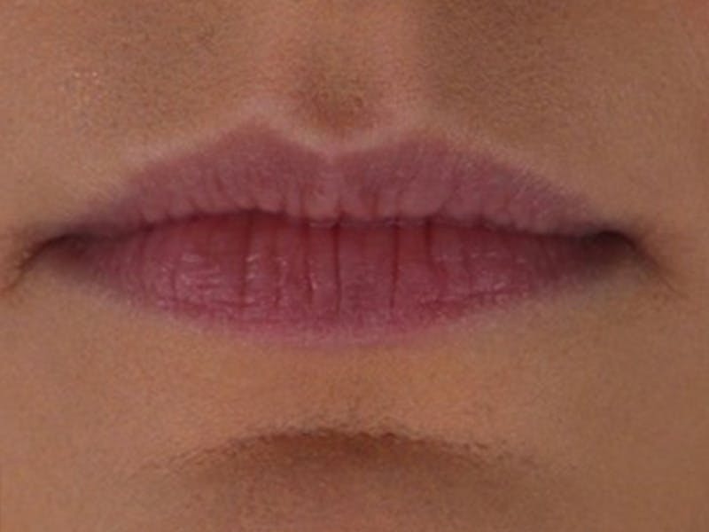 Lip Filler Before & After Gallery - Patient 87555309 - Image 3