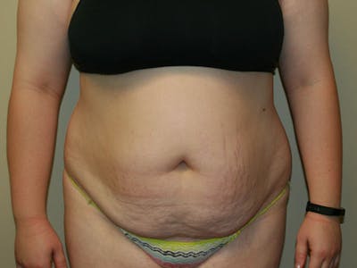 Tummy Tuck Before & After Gallery - Patient 87555307 - Image 1