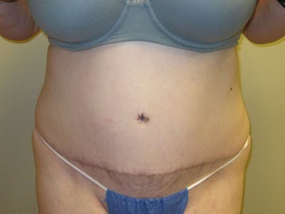 Tummy Tuck Before & After Gallery - Patient 87555307 - Image 2