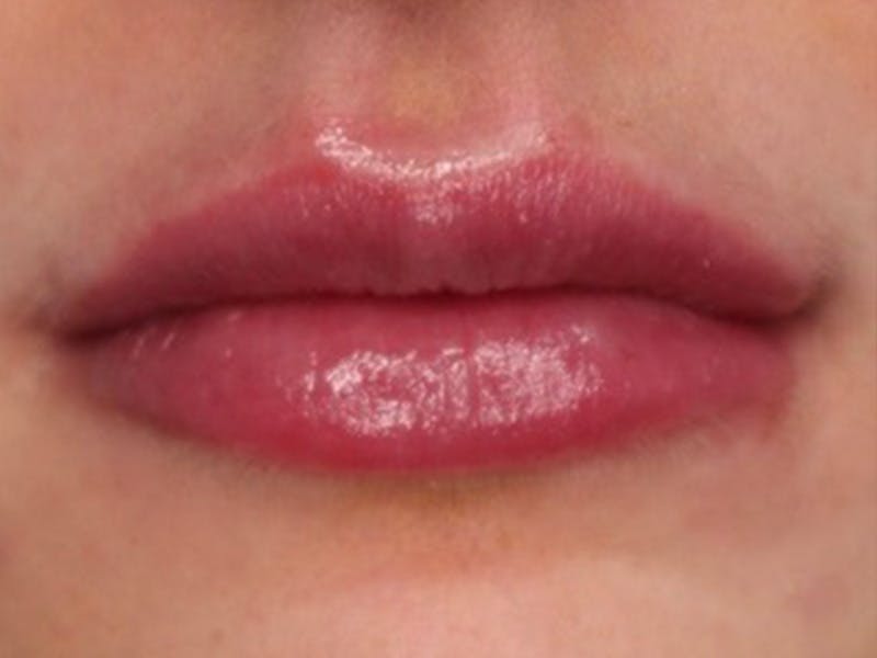 Lip Filler Before & After Gallery - Patient 87555309 - Image 4