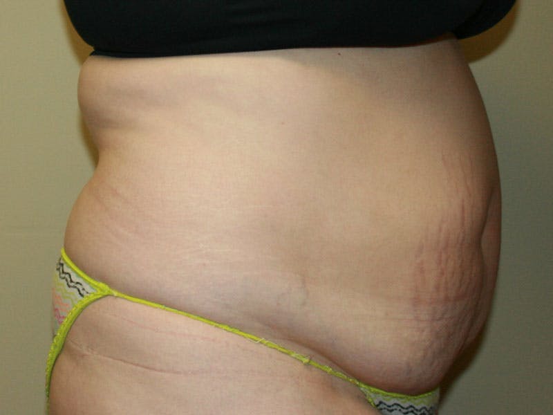 Tummy Tuck Before & After Gallery - Patient 87555307 - Image 3