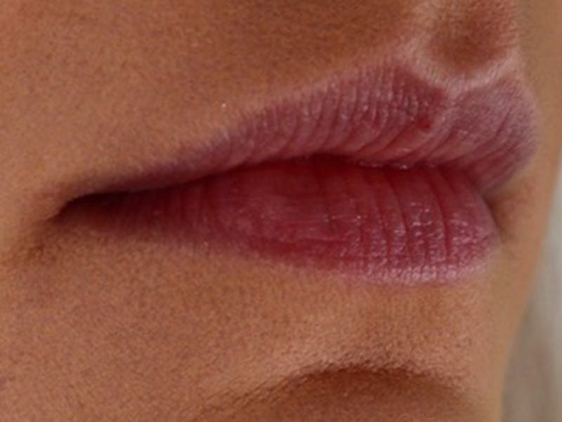 Lip Filler Before & After Gallery - Patient 87555309 - Image 5