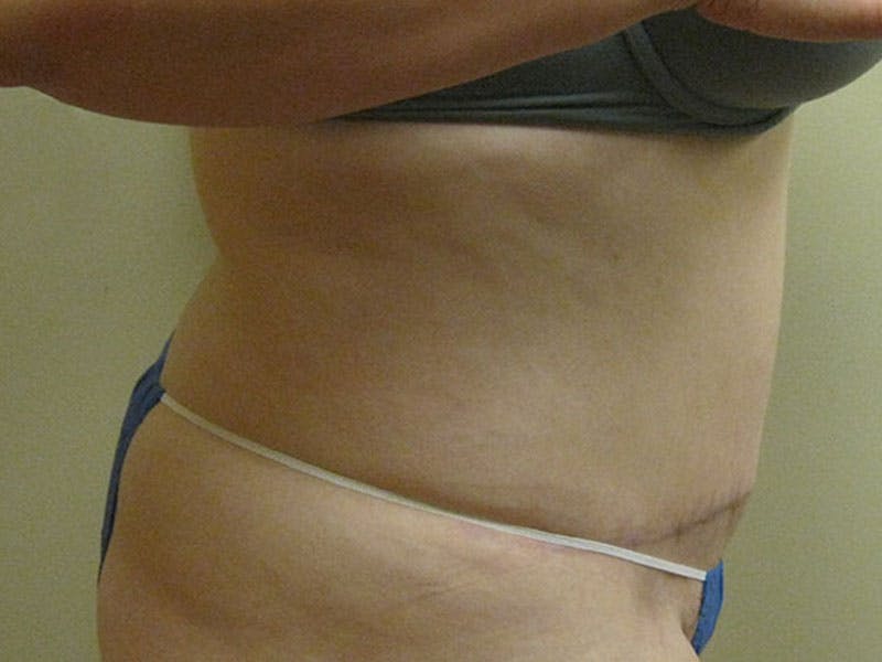Tummy Tuck Before & After Gallery - Patient 87555307 - Image 4