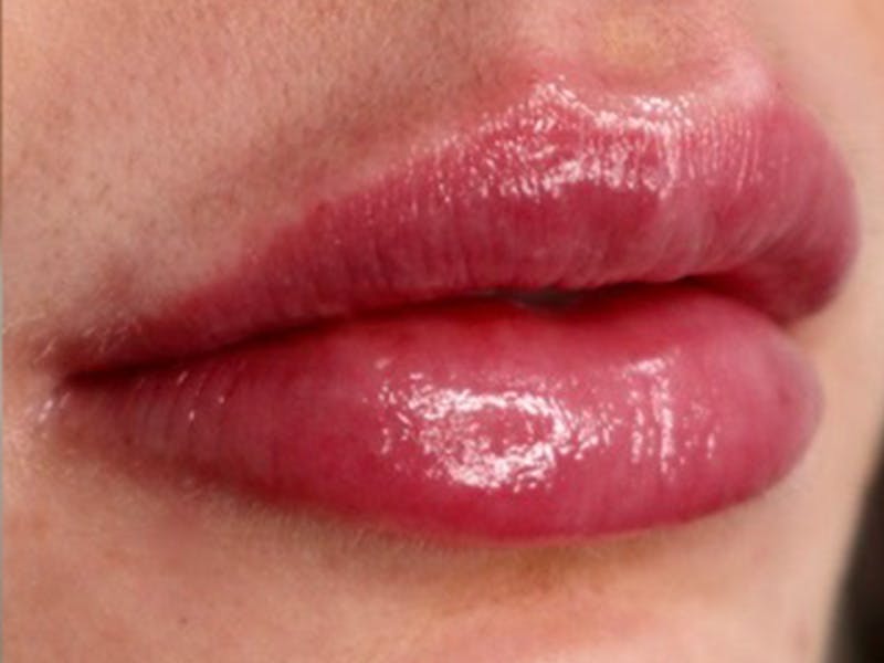 Lip Filler Before & After Gallery - Patient 87555309 - Image 6
