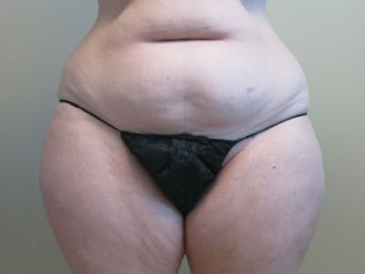 Tummy Tuck Before & After Gallery - Patient 87555321 - Image 1