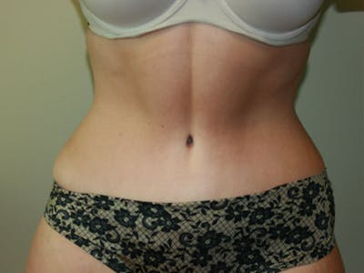 Tummy Tuck Before & After Gallery - Patient 87555321 - Image 2
