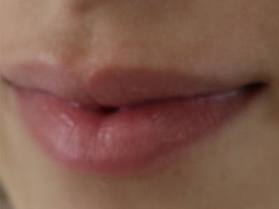 Lip Filler Before & After Gallery - Patient 87555322 - Image 1