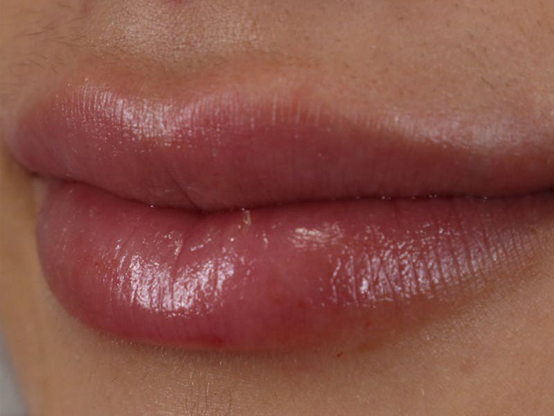 Lip Filler Before & After Gallery - Patient 87555322 - Image 2