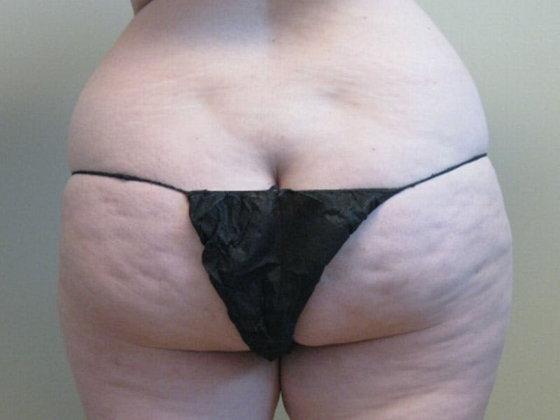 Tummy Tuck Before & After Gallery - Patient 87555321 - Image 3